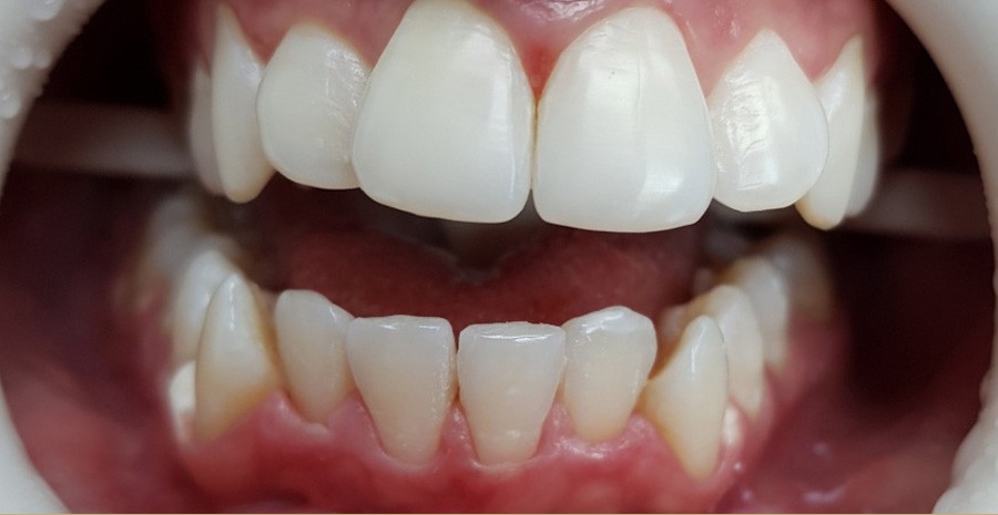Before Whitening-Laser 4